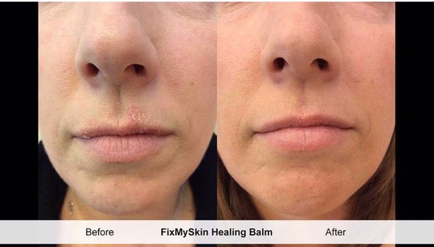 FixMySkin 1% Hydrocortisone Healing Lip Balm – Unflavored