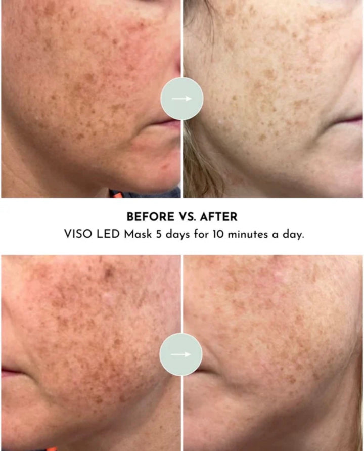 Lumara VISO -Anti-Aging Red Light Mask