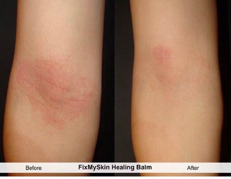 FixMySkin 1% Hydrocortisone Healing Body Balm